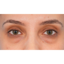 IPL (Intense Pulsed Light) Before & After Patient #2972
