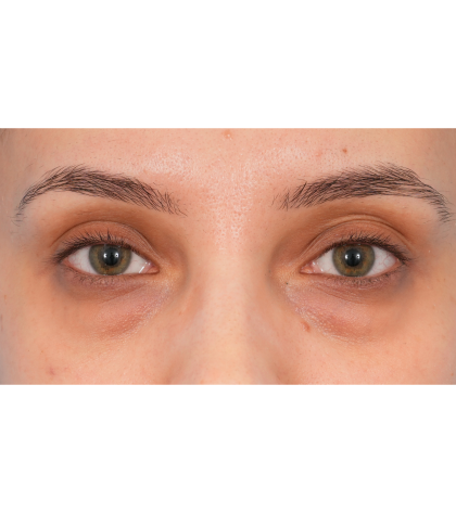 IPL (Intense Pulsed Light) Before & After Patient #2972