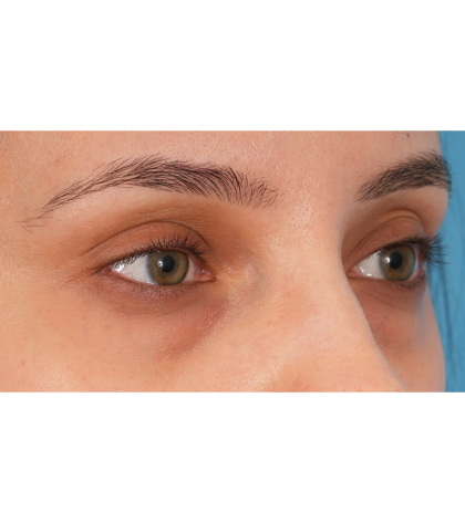 IPL (Intense Pulsed Light) Before & After Patient #2972