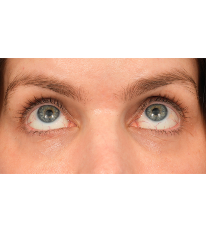 Lower Blepharoplasty Before & After Patient #2988