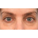 Lower Blepharoplasty Before & After Patient #2988