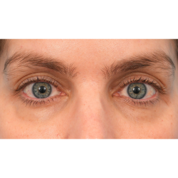 Lower Blepharoplasty Before & After Patient #2988