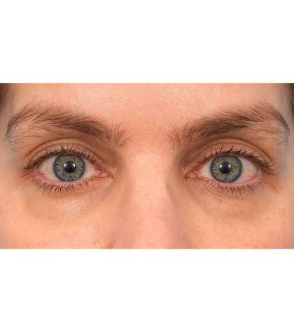 Lower Blepharoplasty Before & After Patient #2988