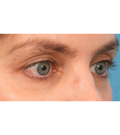 Lower Blepharoplasty Before & After Patient #2988