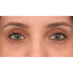 IPL (Intense Pulsed Light) Before & After Patient #2972