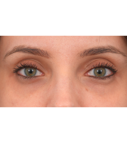 IPL (Intense Pulsed Light) Before & After Patient #2972
