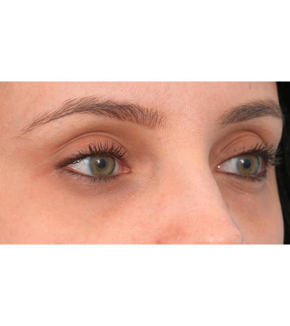 IPL (Intense Pulsed Light) Before & After Patient #2972