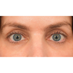 Lower Blepharoplasty Before & After Patient #2988