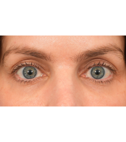 Lower Blepharoplasty Before & After Patient #2988