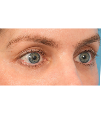 Lower Blepharoplasty Before & After Patient #2988