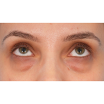 IPL (Intense Pulsed Light) Before & After Patient #2972