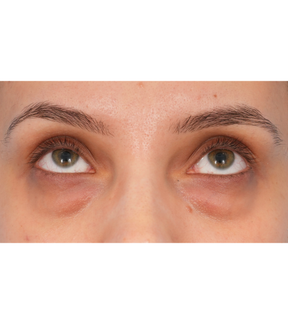 IPL (Intense Pulsed Light) Before & After Patient #2972