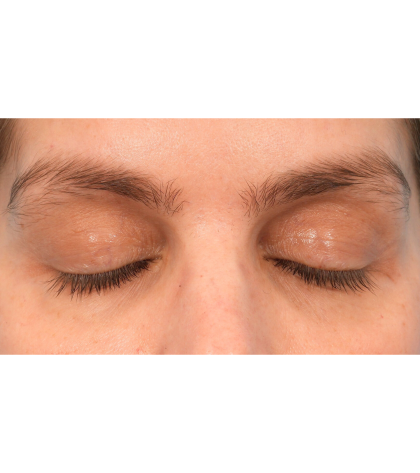 Lower Blepharoplasty Before & After Patient #2988