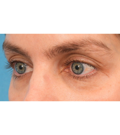 Lower Blepharoplasty Before & After Patient #2988