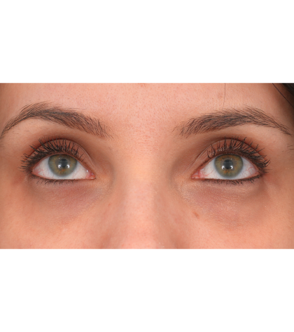 IPL (Intense Pulsed Light) Before & After Patient #2972