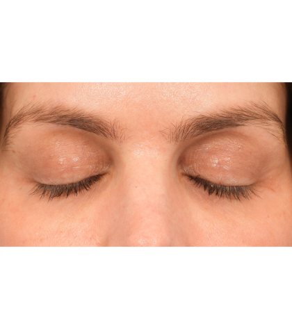 Lower Blepharoplasty Before & After Patient #2988