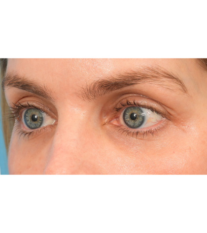 Lower Blepharoplasty Before & After Patient #2988