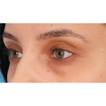 IPL (Intense Pulsed Light) Before & After Patient #2972