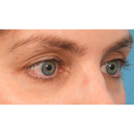 Lower Blepharoplasty Before & After Patient #2988