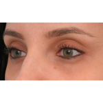 IPL (Intense Pulsed Light) Before & After Patient #2972