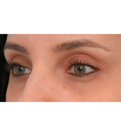 IPL (Intense Pulsed Light) Before & After Patient #2972