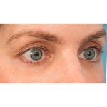 Lower Blepharoplasty Before & After Patient #2988