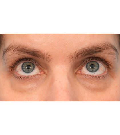 Lower Blepharoplasty Before & After Patient #2988