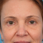 CO2 Laser Resurfacing Before & After Patient #3014
