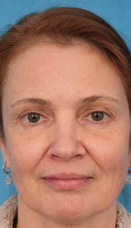 CO2 Laser Resurfacing Before & After Patient #3014