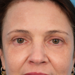 CO2 Laser Resurfacing Before & After Patient #3014