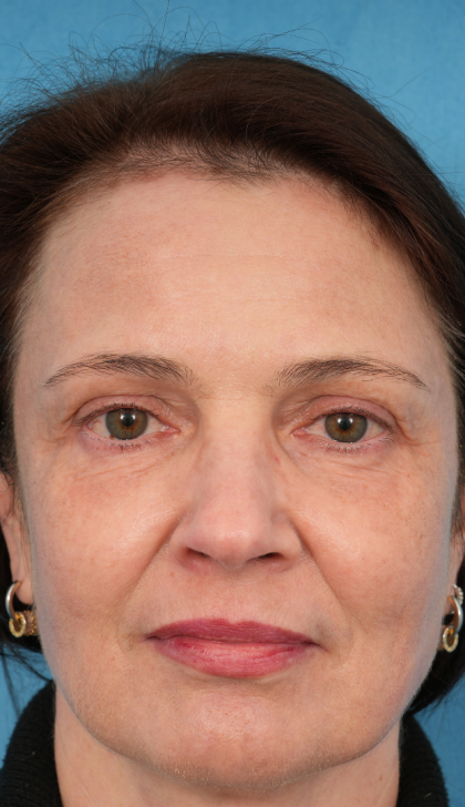 CO2 Laser Resurfacing Before & After Patient #3014