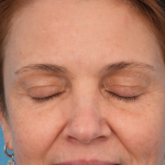 CO2 Laser Resurfacing Before & After Patient #3014