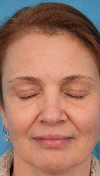 CO2 Laser Resurfacing Before & After Patient #3014