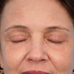 CO2 Laser Resurfacing Before & After Patient #3014