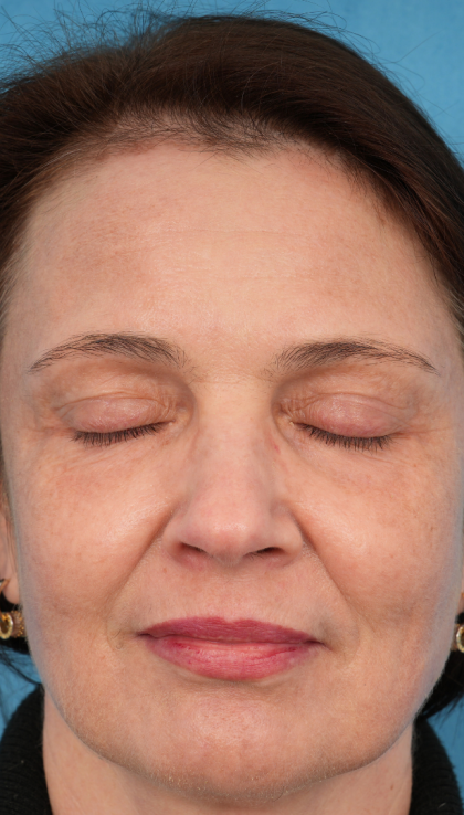 CO2 Laser Resurfacing Before & After Patient #3014