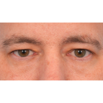 Upper Blepharoplasty Before & After Patient #3062