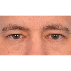 Upper Blepharoplasty Before & After Patient #3062