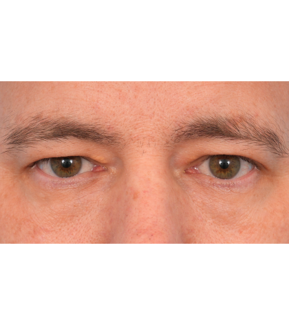 Upper Blepharoplasty Before & After Patient #3062