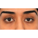 Ptosis Repair Before & After Patient #3024