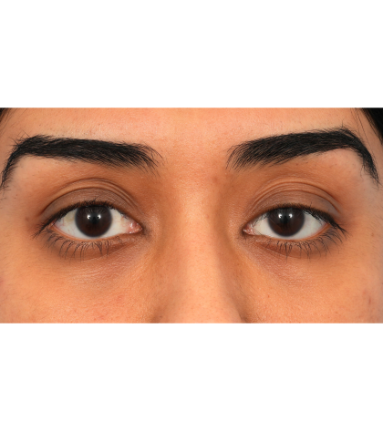 Ptosis Repair Before & After Patient #3024