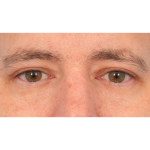 Upper Blepharoplasty Before & After Patient #3062