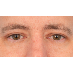 Upper Blepharoplasty Before & After Patient #3062