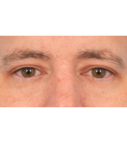 Upper Blepharoplasty Before & After Patient #3062