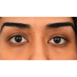 Ptosis Repair Before & After Patient #3024