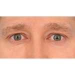 Vein Removal Before & After Patient #3080