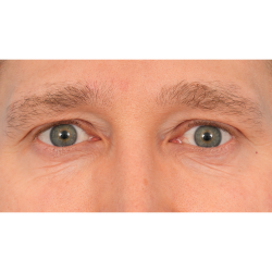 Vein Removal Before & After Patient #3080