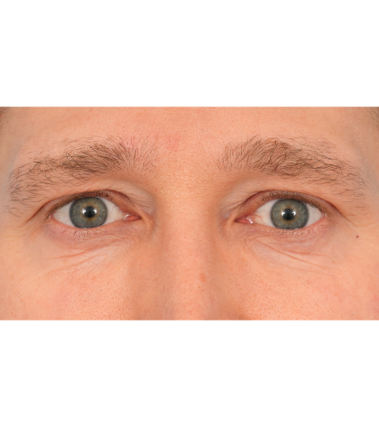 Vein Removal Before & After Patient #3080