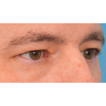 Upper Blepharoplasty Before & After Patient #3062