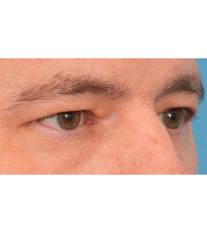 Upper Blepharoplasty Before & After Patient #3062