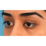 Ptosis Repair Before & After Patient #3024